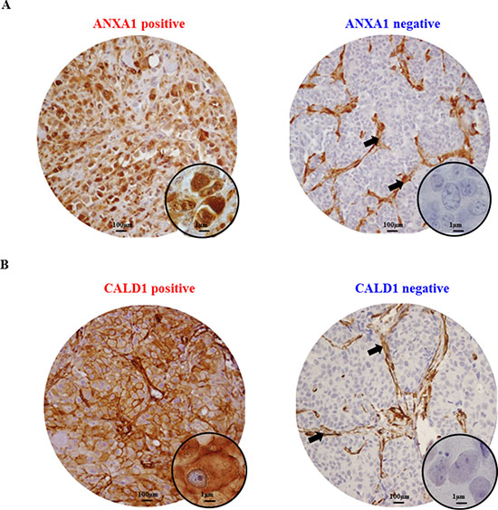 Immunohistochemical stainings of ANXA1 and CALD1 proteins.