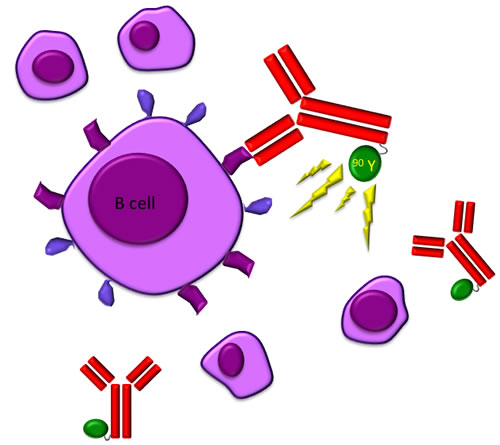 The radio-labeled antibody 90 Y-ibritumomab tiuxetan (Zevalin) binds to cells with CD20 receptors producing a crossfire effect.