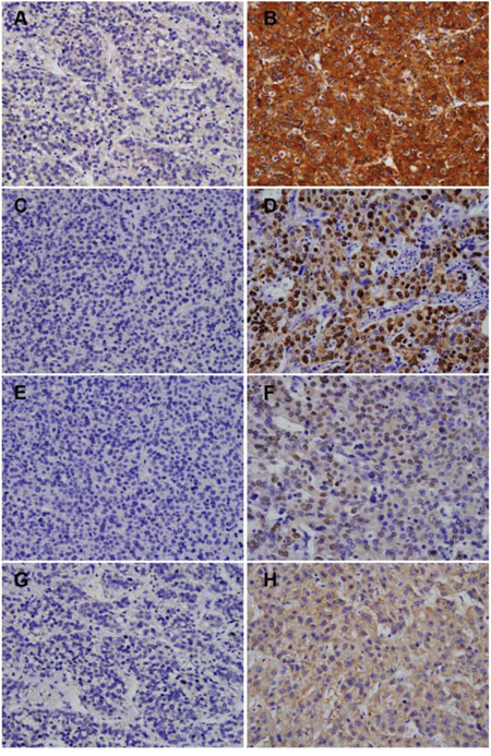 Expression of miR-145, miR-31, miR-92a, and miR-10b in hepatocellular carcinoma tissue microarrays.