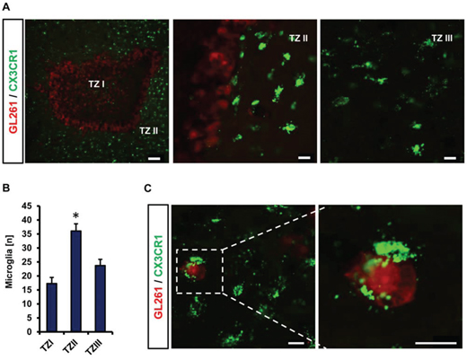 Microglia distribution and interaction in different tumor zones.