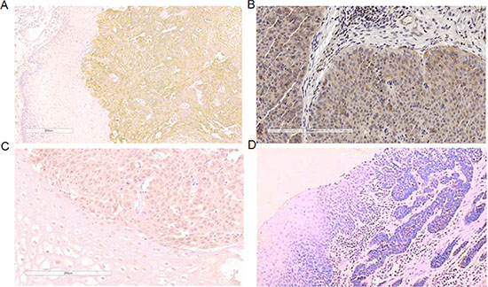 Expression of MUC4/MUC13/MUC20 protein in ESCC.