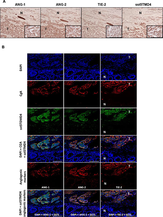 Expression of sst5TMD4 and co-localization with angiogenic marker in GEP-NET.