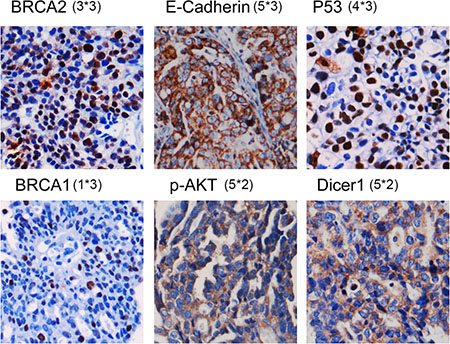 Representative IHC staining for these six SVM-RFE&#x2013;selected markers in HGSOC tumor tissues.