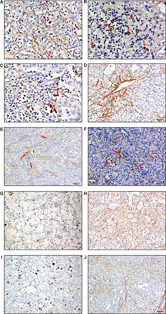 MICAL2 is abnormally expressed in human kidney cancer.