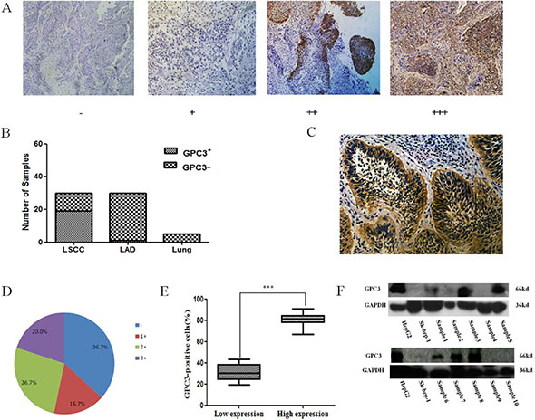 GPC3 expression in lung cancer tissues.
