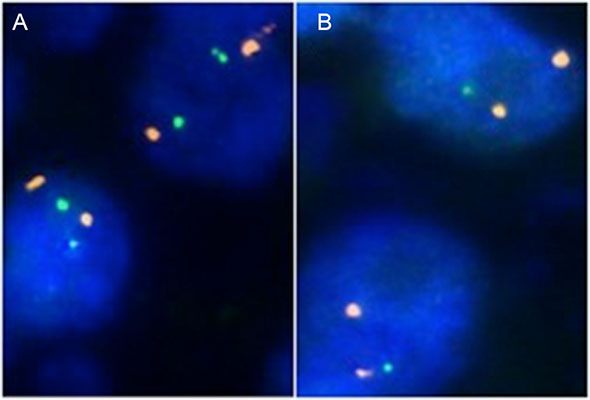 Examples of FISH findings showing (A) normal 6q15 signal numbers and (B) heterozygous 6q15 deletion.