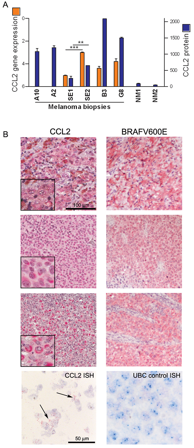 CCL2 is expressed by melanoma cells in tumor tissues from patients.