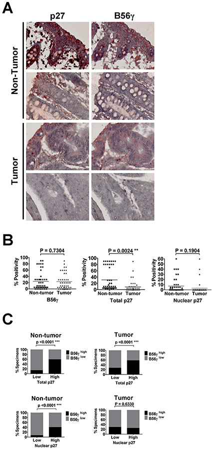 IHC analysis of p27 and B56&#x03B3; proteins in human colon cancer specimens reveals positive correlation between levels of p27 and B56&#x03B3;.