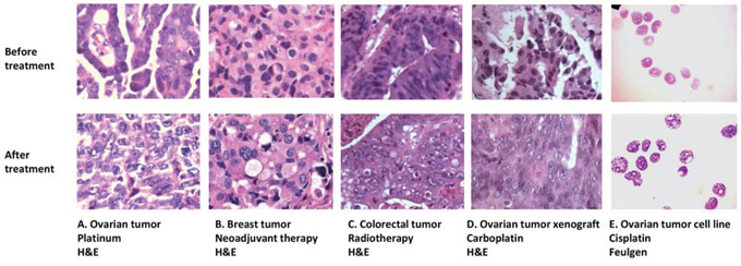 Figure 1. Nuclear morphology changes in different clinical and experimental settings. Similar nuclear texture changes occur in: