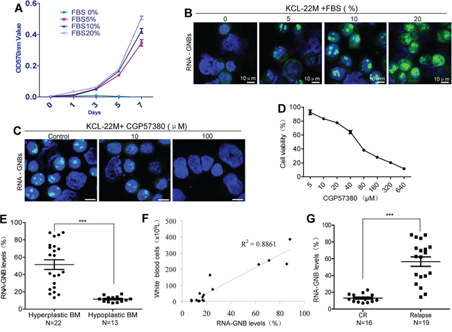 GNB abundance is positively correlated with cell proliferation, tumor burden and outcome of therapy in human leukemia