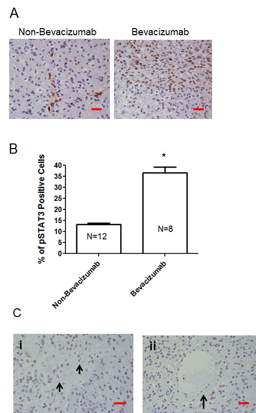 The p-STAT3 pathway is up regulated during treatment failure of anti-VEGF therapies in human GB patients.