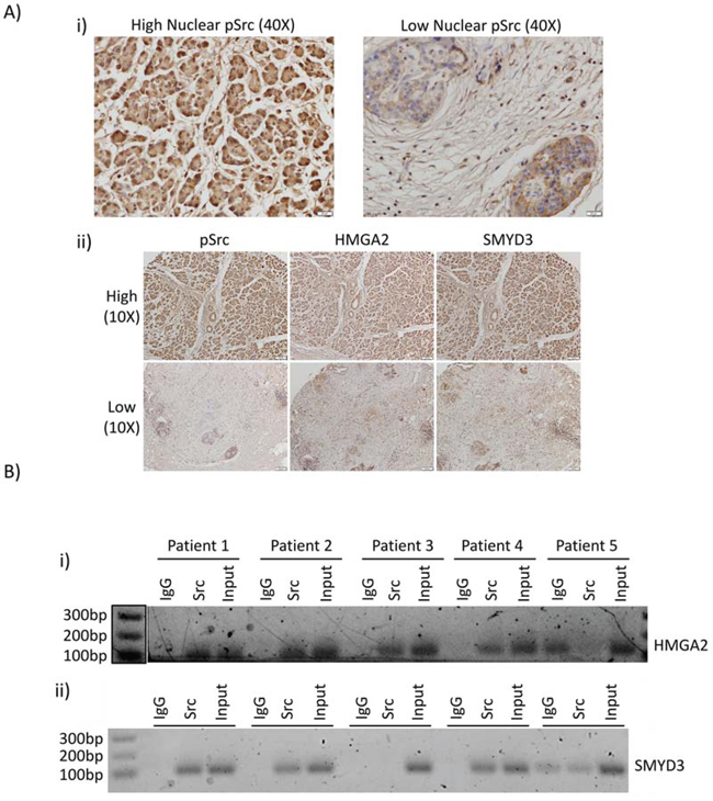 Nuclear Src activation and association with HMGA2 and SMYD3 gene promoters are observed in patient samples of PDAC.