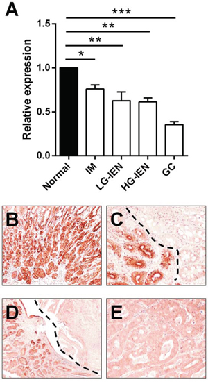 Let-7c is significantly down-regulated during Helicobacter pylori-related gastric carcinogenesis.