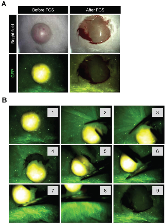 Figure 3. OBP-401 based FGS of melanoma using the Dino-Lite hand-held portable fluorescence scope.