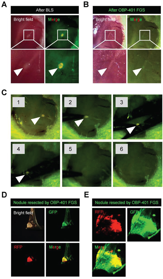 Figure 4. OBP-401 targeting visualizes residual malignant melanoma cells after BLS.
