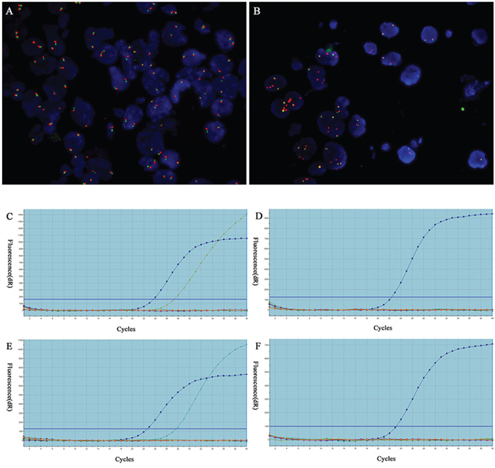 Detection of ALK fusion by FISH and EGFR/KRAS mutations in cytological specimens by qRT-PCR.