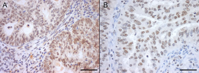 Nuclear SIRT1 (A) and SIRT7 (B) protein immunoexpression in endometrial carcinomas, with marked nucleolar staining in SIRT7 (Bar = 50 &micro;m).