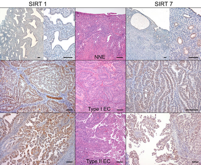 SIRT1 and SIRT7 protein immunoexpression in endometrial carcinomas and non-neoplastic endometria (Bar = 100 &micro;m).