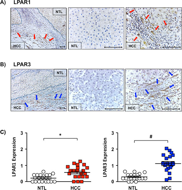 Increased LPAR1 and LPAR3 expression localized to the HCC-NTL margin. (A)