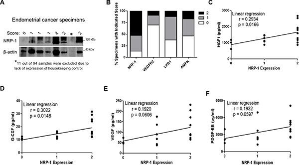 Association of NRP-1 with tumor-enhancing cytokines in endometrial cancer specimens.