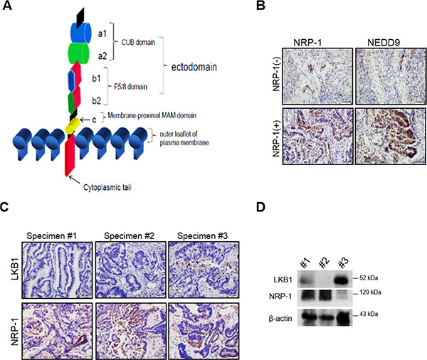 NRP-1 expression positively correlates with metastasis-enhancing NEED9 in human endometrial cancer specimens.