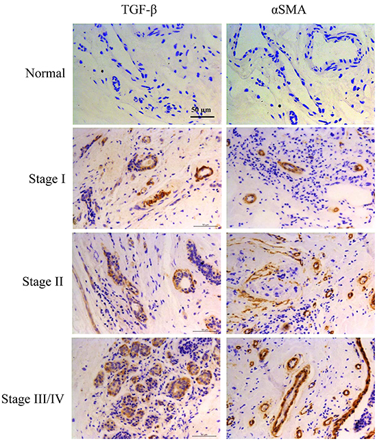 Expression of TGF-&#x03B2; and CAFs maker &#x03B1;-SMA were both increased in tumor tissues of breast cancer patients.