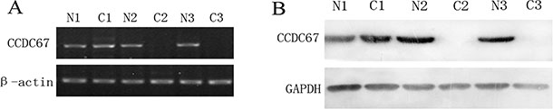 Expression status of CCDC67 in PTC tumors (C) and matched adjacent normal thyroid tissues (N).