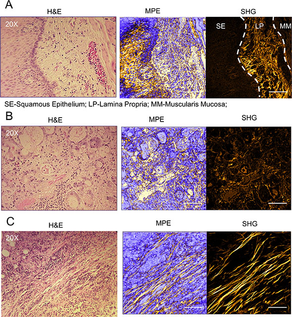 Aligned and elongated collagen fibers are found in the tumor microenvironment.