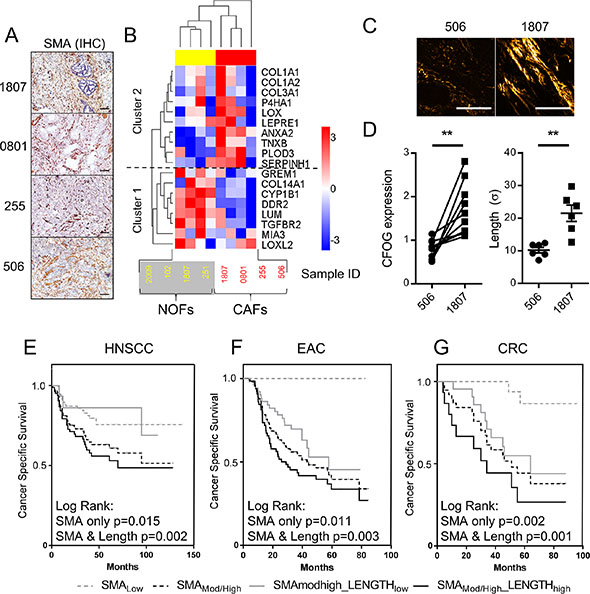 CAFs exhibit significant heterogeneity in the ability to manipulate collagen structure, critically determining patient survival rates.