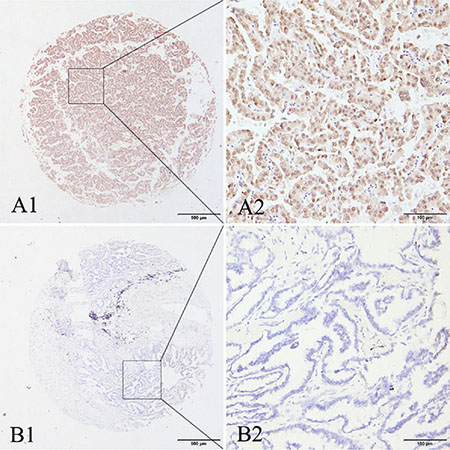 Representative patterns of MAGE-A9 protein expression in lung adenocarcinoma and adjacent noncancerous tissues.