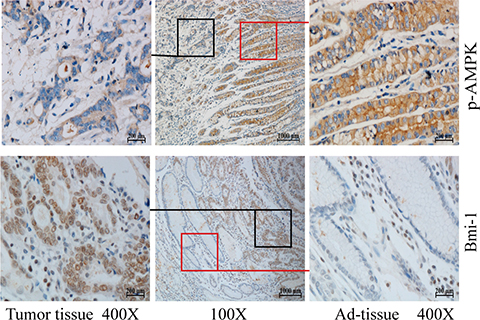 Phosphorylation of AMPK and Bmi-1 expression in gastric cancer.