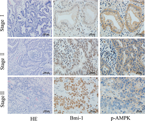 Phosphorylation of AMPK and Bmi-1 expression in lung cancer.