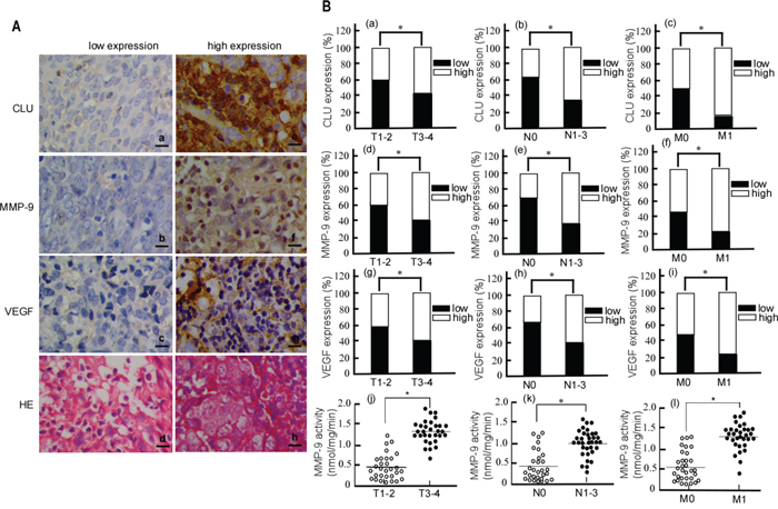 The immunohistochemical staining of CLU, MMP-9 and VEGF in NPC tissues.