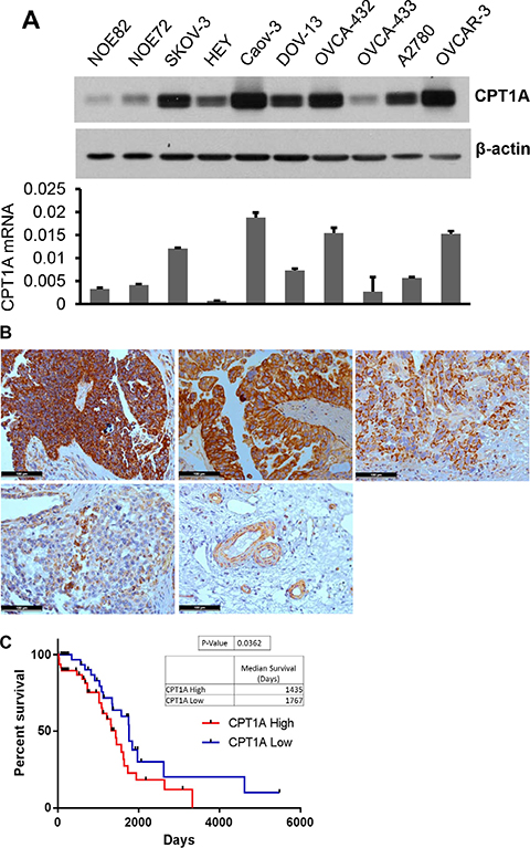 CPT1A is highly expressed in ovarian cancer and its expression correlates with poor survival of patients.