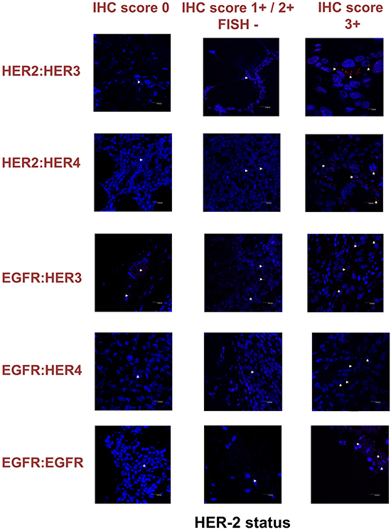 Dimer formation pattern in three groups of human breast cancer tissues based on HER-2 expression profile is shown in representative fluorescence images.