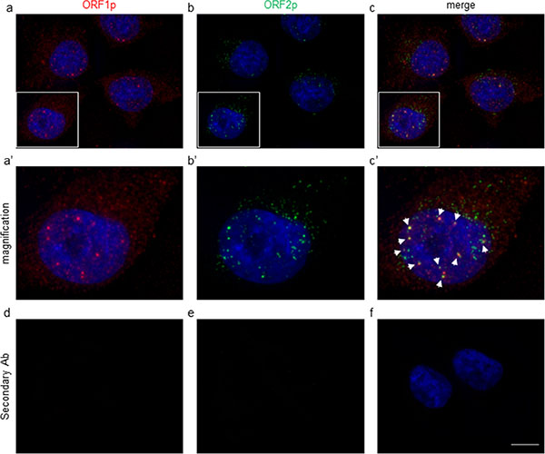 Immunofluorescence assay of A-375 cells stained with anti-ORF1p polyclonal (red, a) and chA1-L1 anti-ORF2p monoclonal (green, b) antibodies.