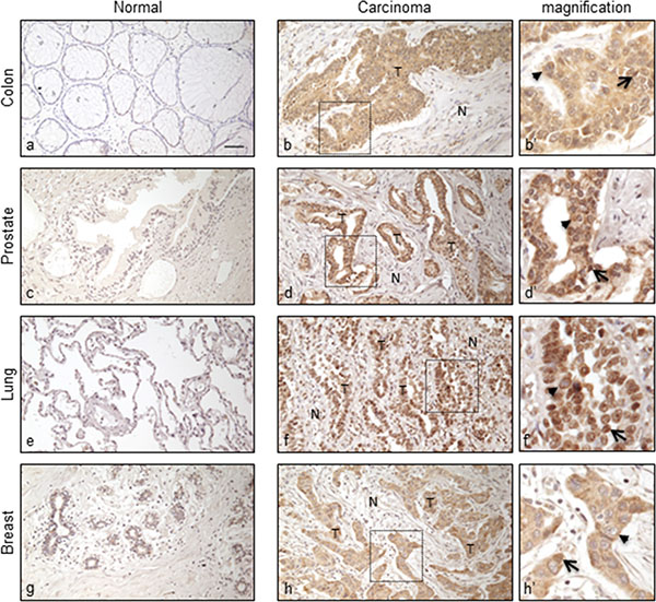 Immunohistochemical staining of ORF2p in human normal and cancer tissue sections.