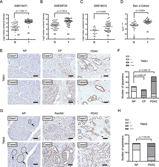 EDIL3 expression is increased in pancreatic cancer.