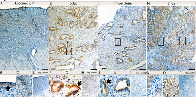 Protein localization of Syncytin-1 in normal and pathological endometrial tissues.