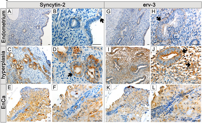 Protein localization of Syncytin-2 and erv-3 in normal and pathological endometrial tissues.