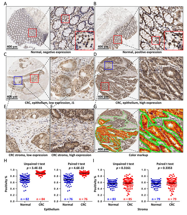 IHC analysis of COL3A1 expression in CRC tissues.