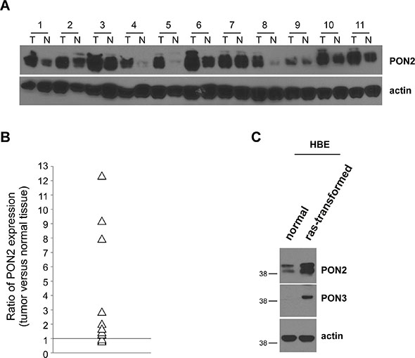 PON2 expression is enhanced in human lung tumor tissues and oncogenically transformed HBE cells.