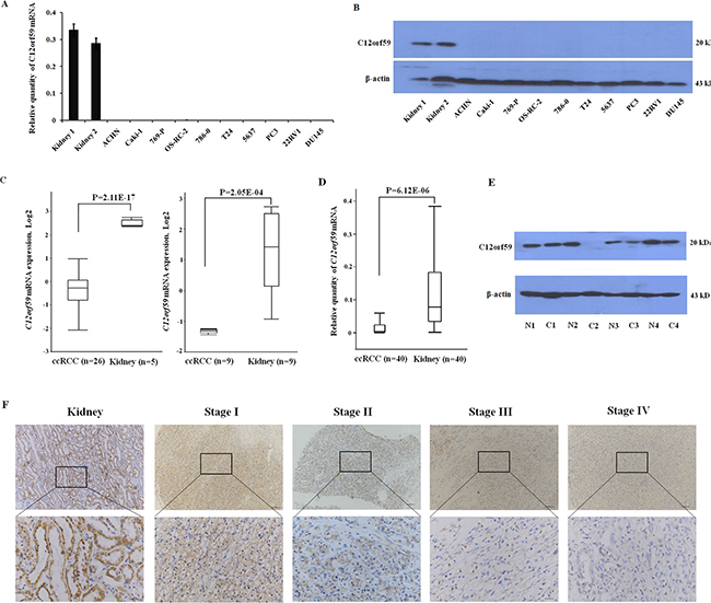 C12orf59 is down-regulated in ccRCC.