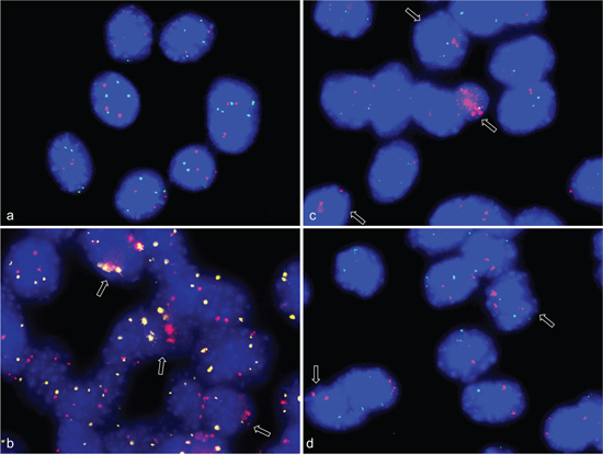 Gene amplifications on chromosomes 8qE2 and 5qF in differentiation induced C2C12 mouse myoblast cells.