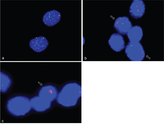 CDK4 gene amplifications on chromosome 10qD3 in differentiation induced C2C12 myoblast cells.
