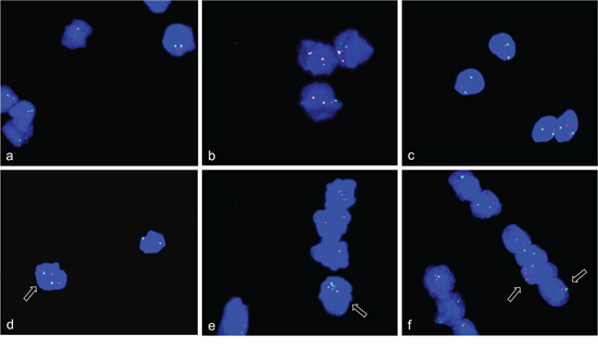 Gene amplifications on chromosomes 12q14-15 and 1q42.13 in differentiation induced HSkM human myoblast cells.