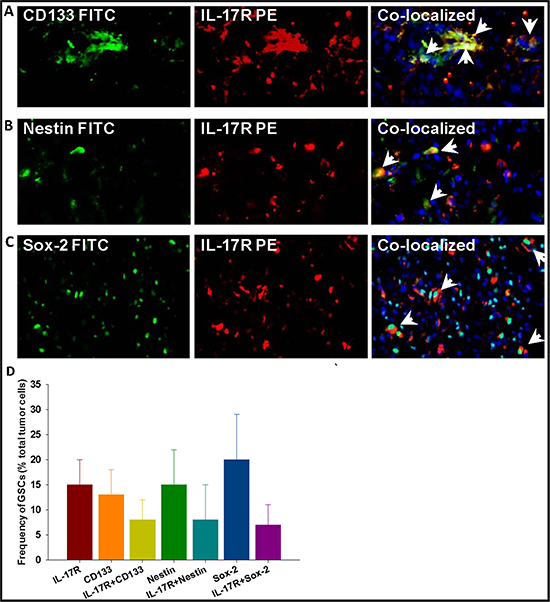 Gliomas express IL-17R which preferentially co-localizes with GSC markers.