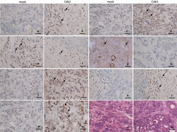 Expression of EMT markers in Cdk3-promoted metastatic tumors.