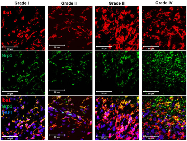 Expression of Nrp1 by glioma-associated microglia/macrophages in human tumor biopsies.
