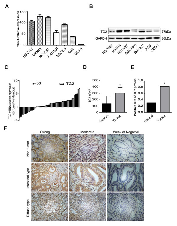 Expression of TG2 in the GC tissues and cell lines.